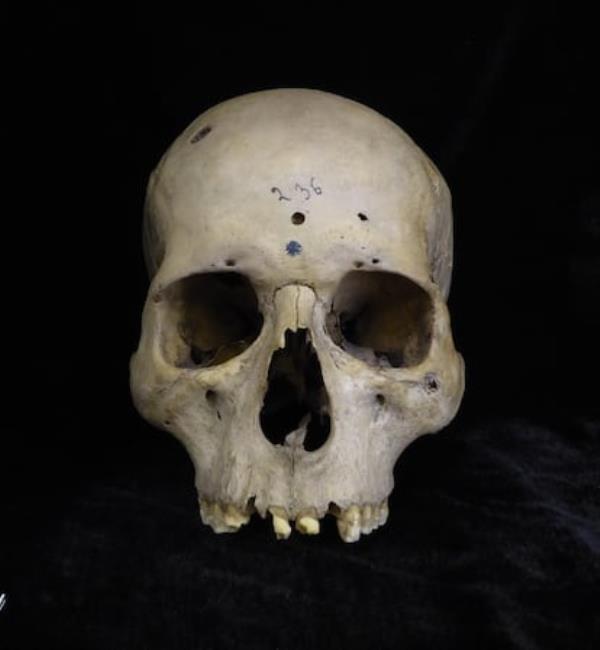 Male skull with circular cancerous lesions.
