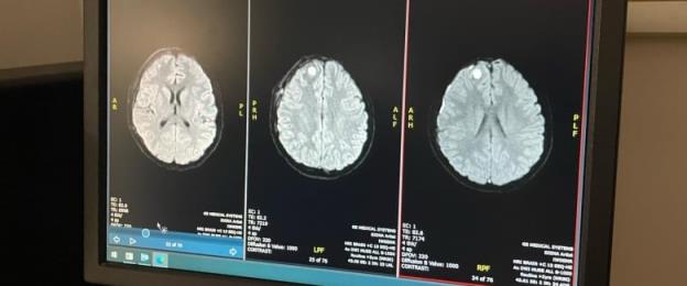 Three black and white brain scans are pictured side by side. A white ball a<em></em>bout the size of blueberry can be seen at the top left corner of two scans.