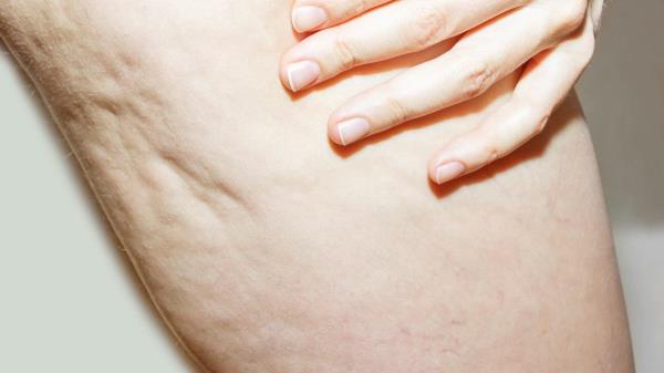 Run to the chemist and buy the oil. It eliminates swelling and cellulite disappears before your eyes. The 