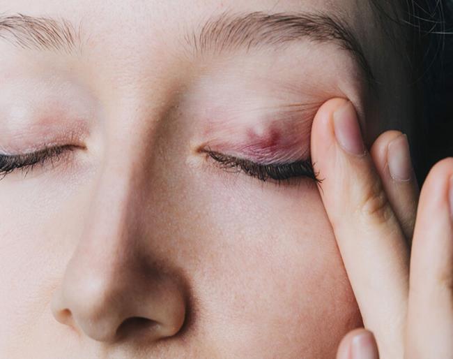 50-facts-a<em></em>bout-chalazion
