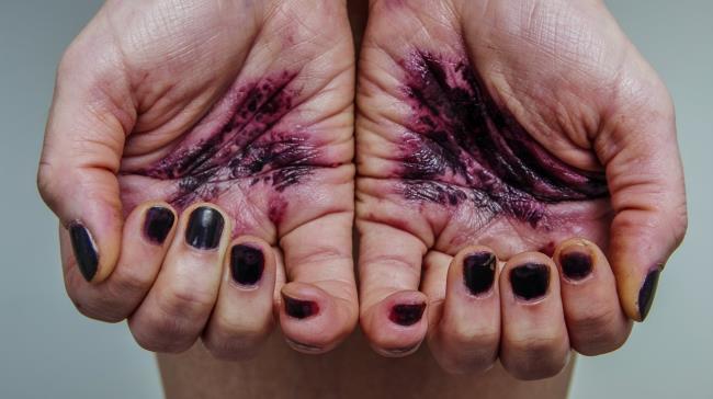 30-facts-a<em></em>bout-congenital-hepatic-porphyria