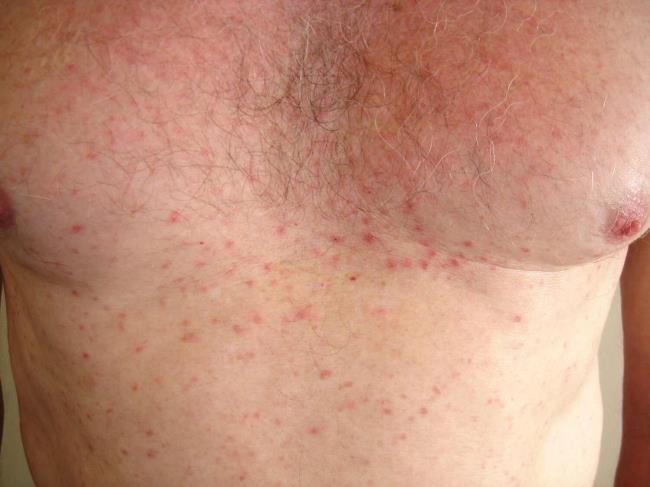 50-facts-a<em></em>bout-grovers-disease