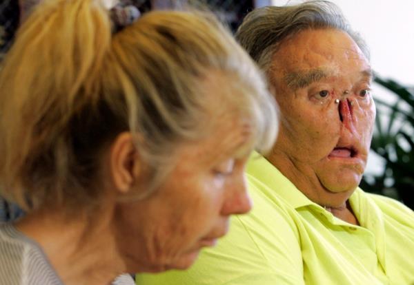A picture showing LaDo<em></em>nna and St. James Davis addressing the media after they were mauled by two chimps shows the extent of St. James' injuries, which included losing much of his nose and an eye.